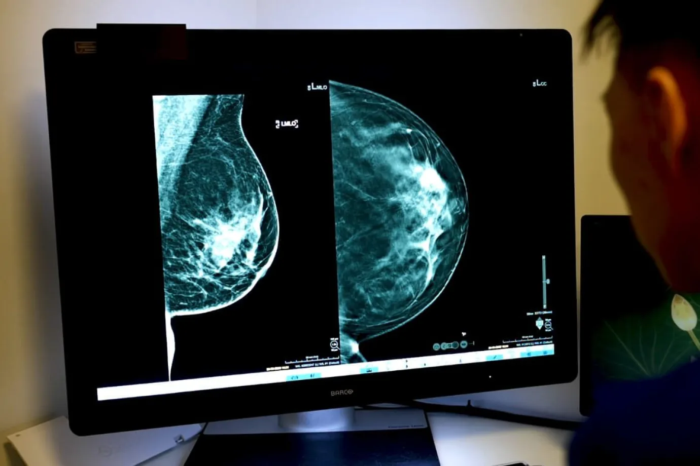 Breast scan